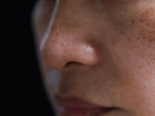 Melasma: o que é, tratamento e tipos