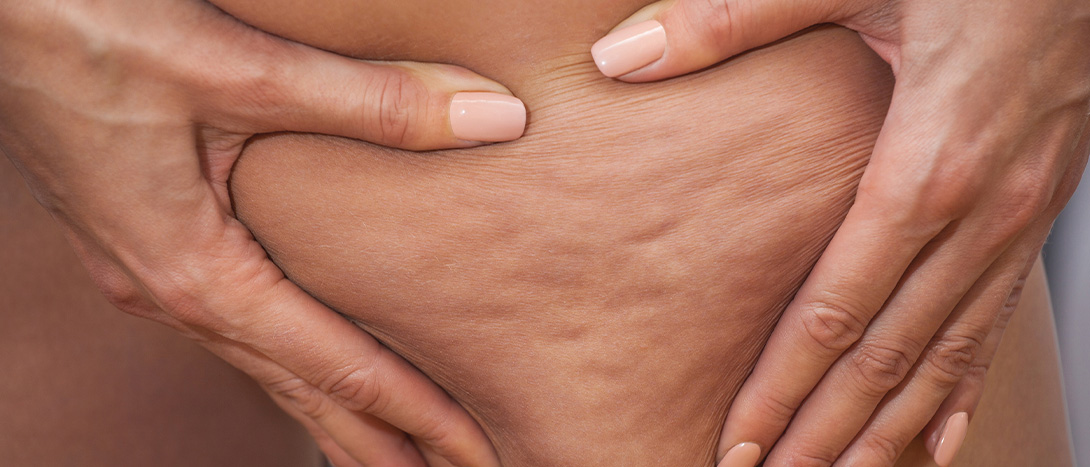 Melhores cremes anti celulite